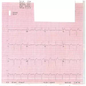 Biventricular Resynchronisation